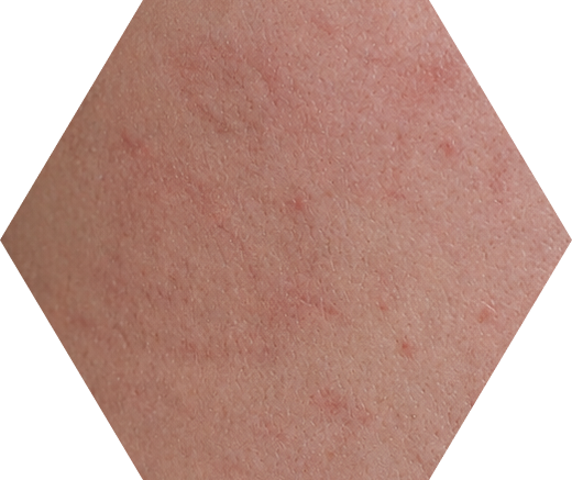 Fragile / Sensitive Skin